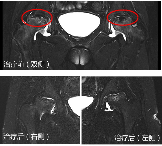 医生巧用砒霜挽救血癌女子生命,医生治股骨头