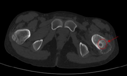 股骨颈肿瘤微创,中医院骨二科