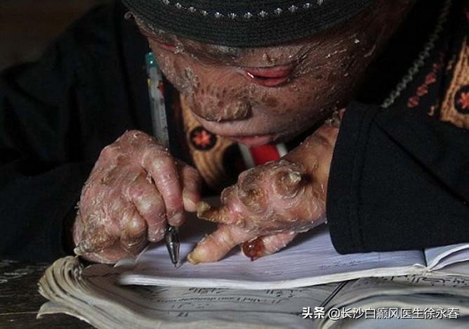 蛇皮肤擦什么药膏,蛇皮肤怎么彻底消除