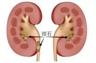 硬水对肾的影响,硬水会对肾脏造成危害吗