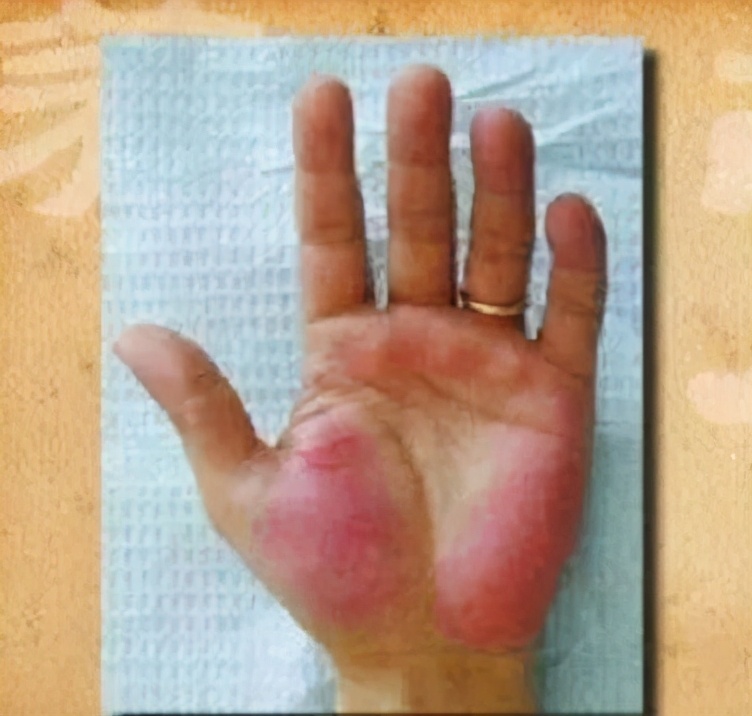 身上的小红点是不是代表得了肝病,身上有红点是肝病的前兆吗