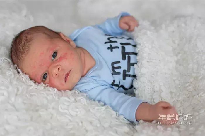 夏季婴儿穿尿不湿有痱子怎么办,宝宝夏季脸上长痱子怎么护理