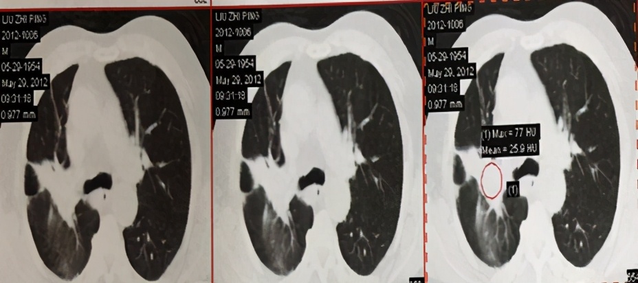 局部放疗能彻底治好吗,放射治疗全过程两大阶段