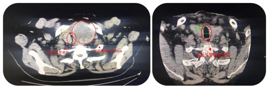 八旬医生抢救老人,老人甲状腺肿大要怎么治疗