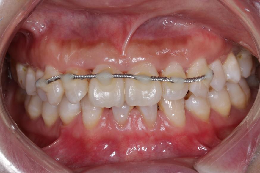 小明的牙齿被撞歪?1:1还原治疗过程,不让意外伤害一颗好牙