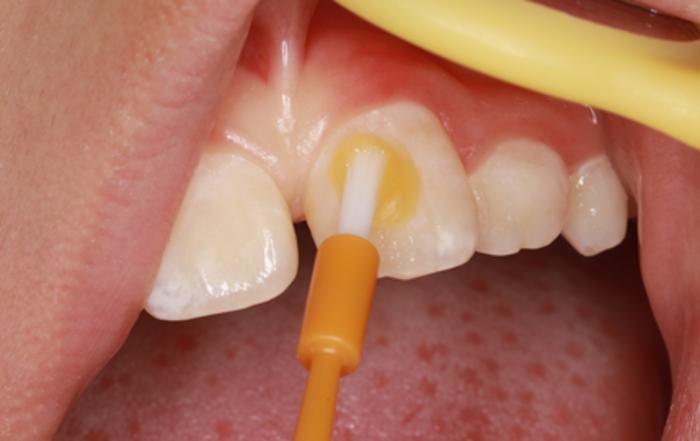 护齿防龋窝沟封闭,窝沟封闭和涂氟防龋哪个好