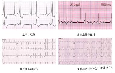 急性重症心肌炎护理查房,急性心肌炎