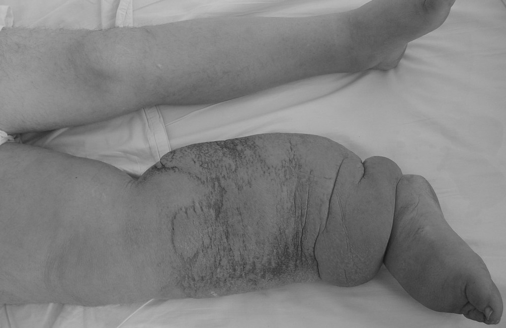 丝虫病大象腿后续,丝虫病在腿上