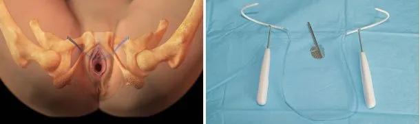 医生说尿尿多怎么办,笑到尿裤子该怎么治疗