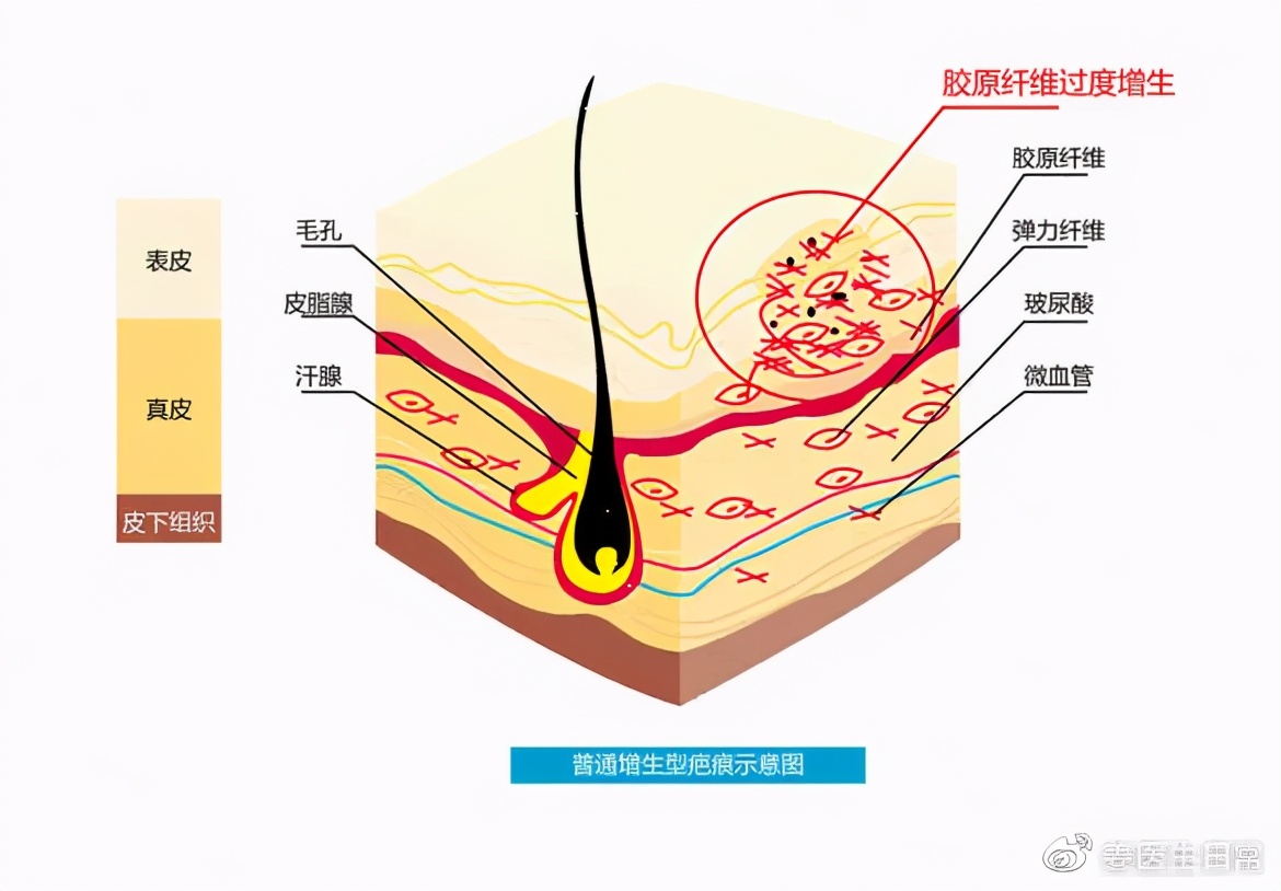 已经形成的疤痕增生怎么去掉,疤痕为什么越长越大