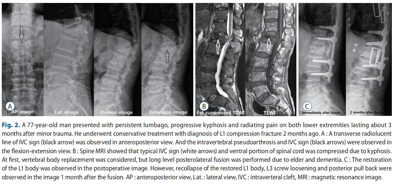 创伤后的右侧颞叶脑出血多久可好,创伤后综合征能恢复吗