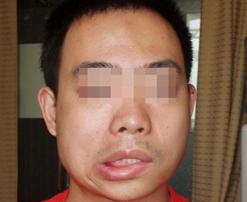 面神经炎和面瘫的区别,面神经炎吃什么药