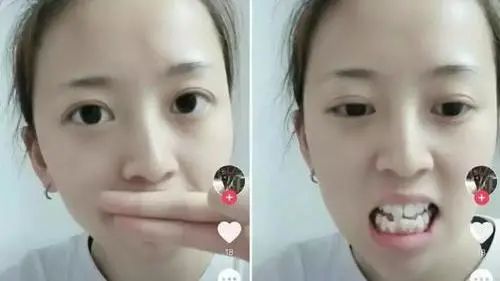 带你了解超详细的牙齿矫正过程,牙齿矫正全过程看完你就知道