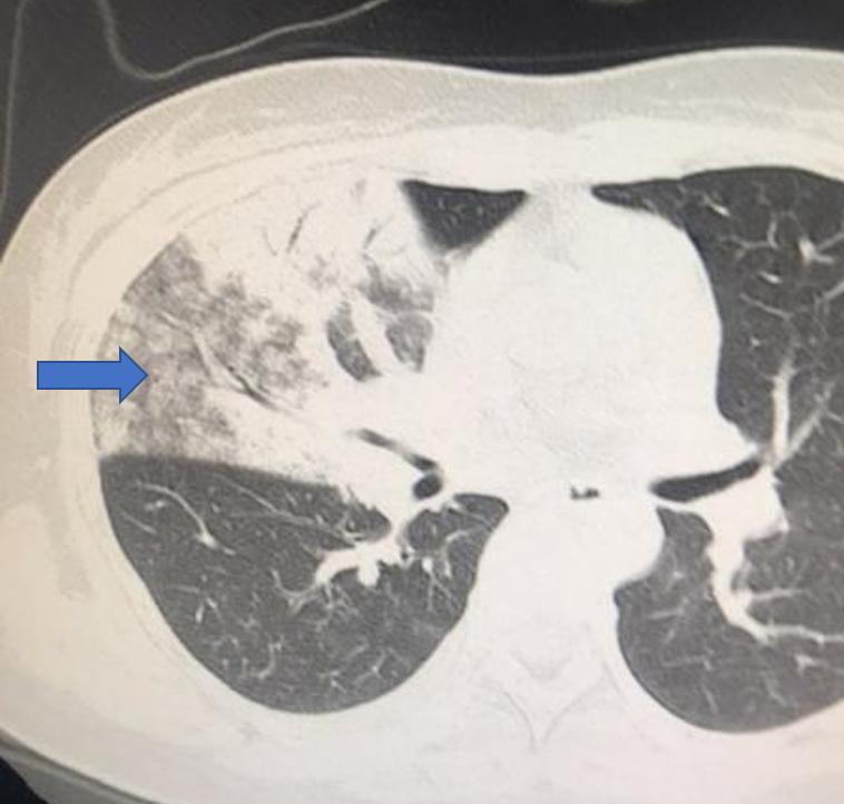 肺部5mm磨玻璃结节最新处理方法,亚实性磨玻璃结节13mmx9mm严重吗
