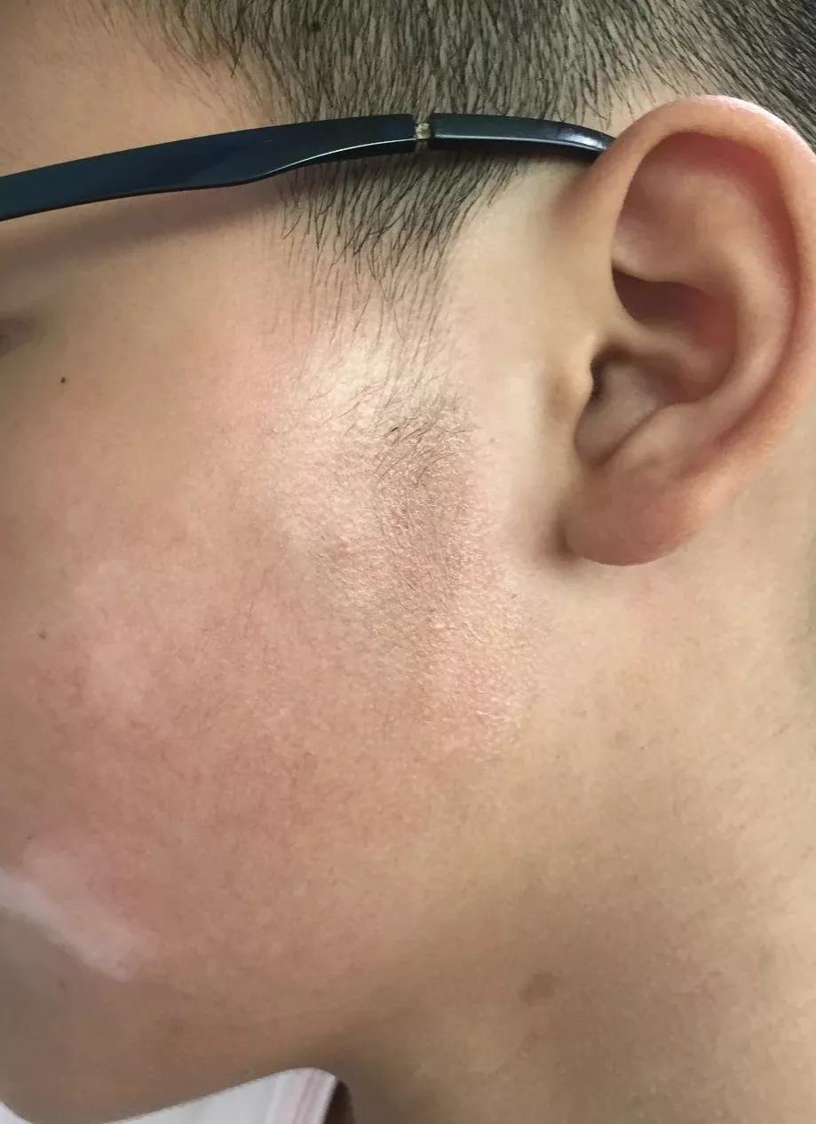 儿童治疗白癜风需要多少钱,uvb治疗白癜风多久见效