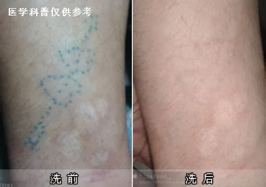 激光祛纹身的正确方法,激光快速祛纹身方法