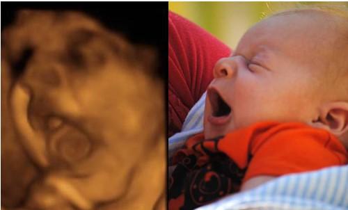 四维彩超图片孩子少一块,四维彩超图看孩子准确