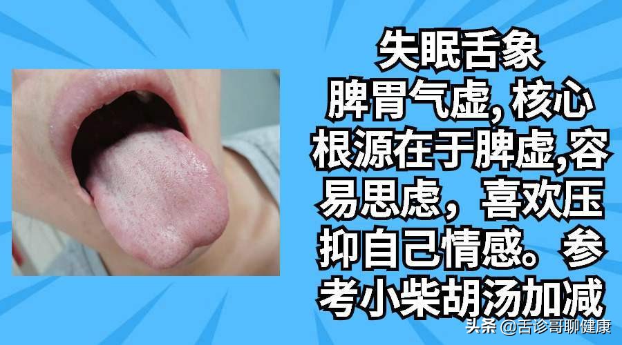 舌诊哥肝郁脾虚,乙肝肝郁脾虚舌象