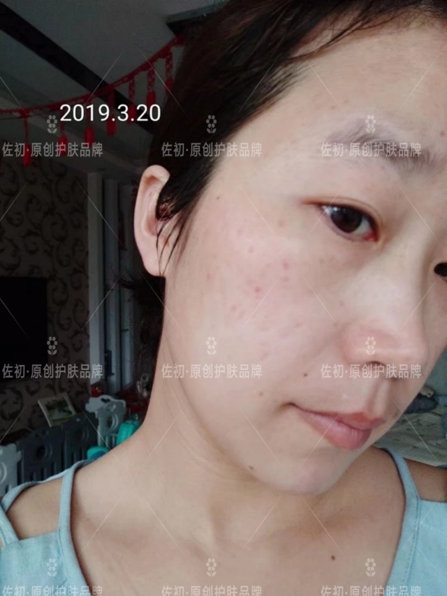 生完孩子烂脸,生完孩子脸上垮了怎样处理