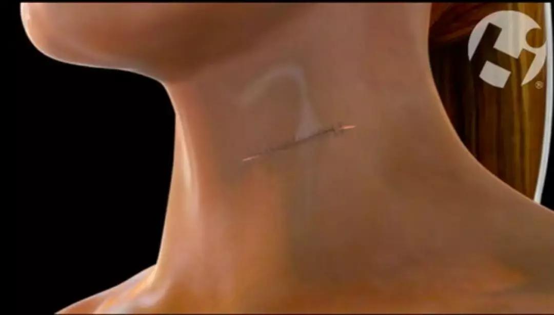 颈椎病是保守治疗还是手术治疗好,颈椎病做什么手术比较安全