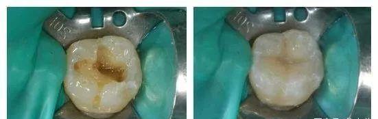 补牙视频过程医生视角,补牙真实全过程