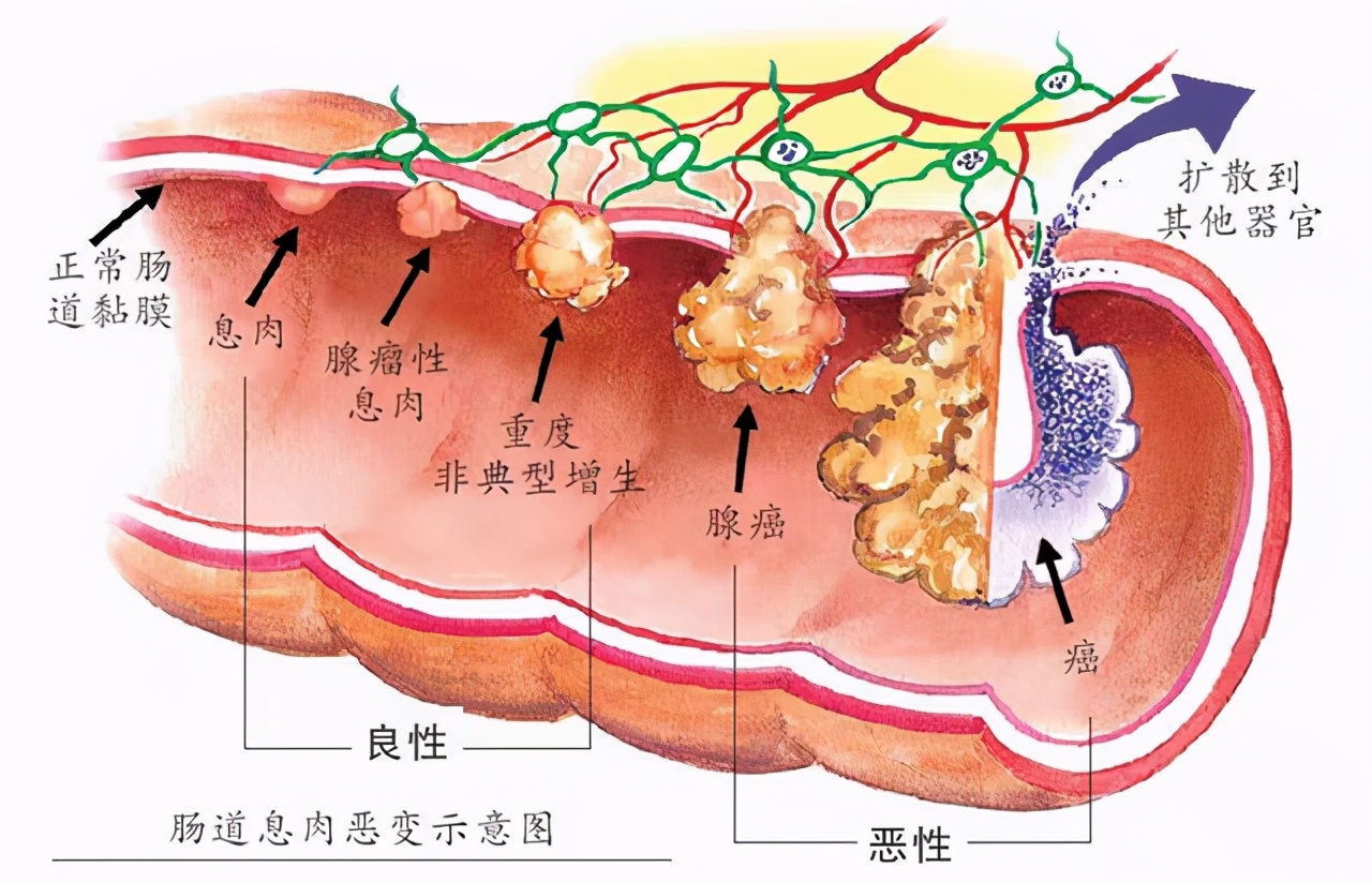 做胃镜发现有息肉建议切除吗,做胃镜发现息肉可以直接切除吗