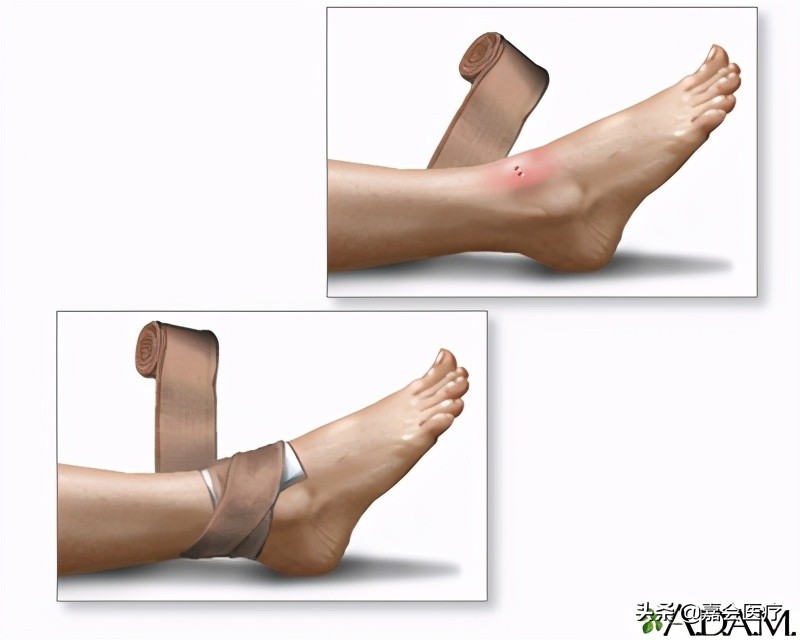 被蛇咬用嘴吸毒,被蛇咬后用嘴吸毒