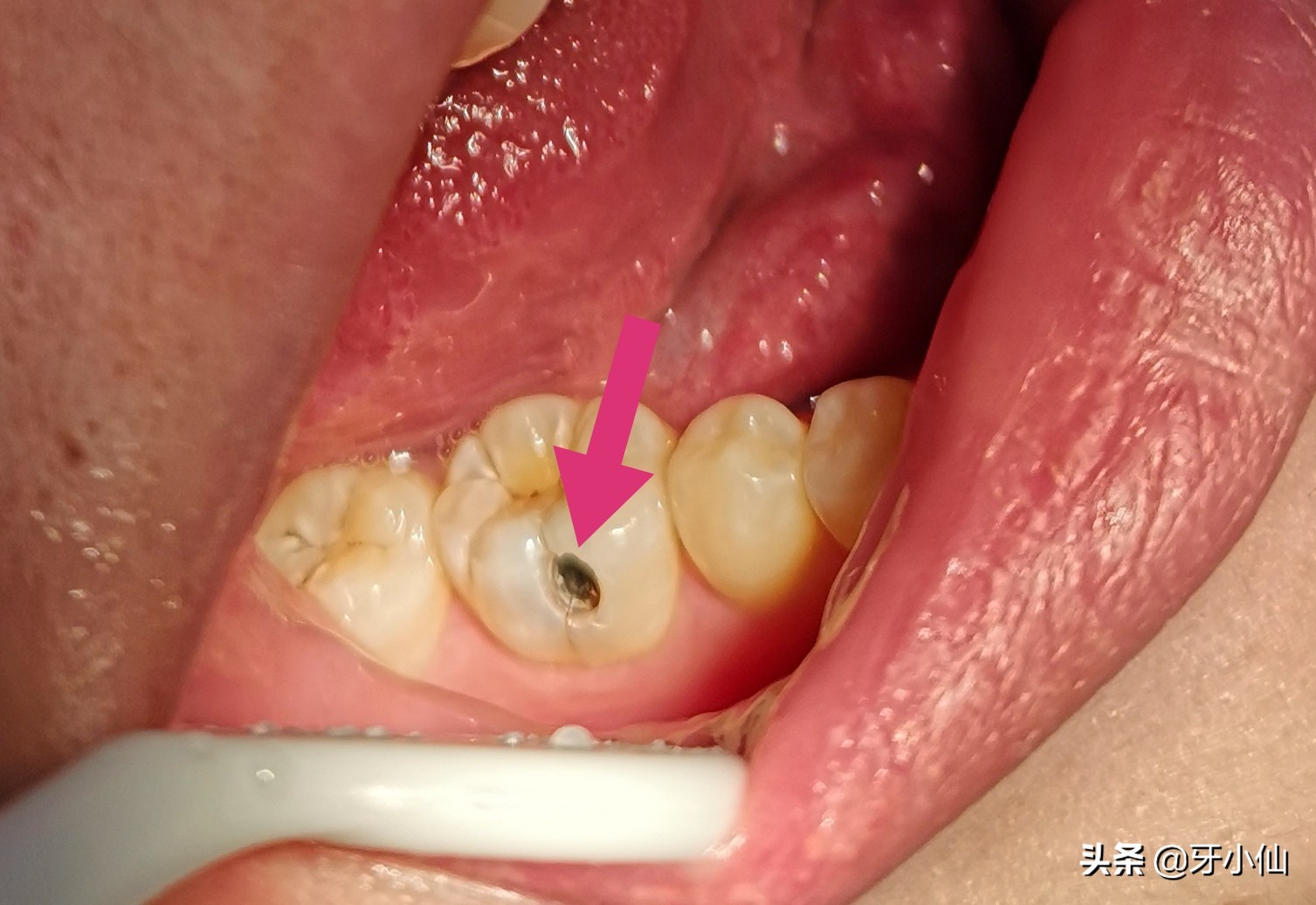 牙太痛,吃不了热辣火锅、冰爽雪糕、酸甜水果,怎么能当吃货?
