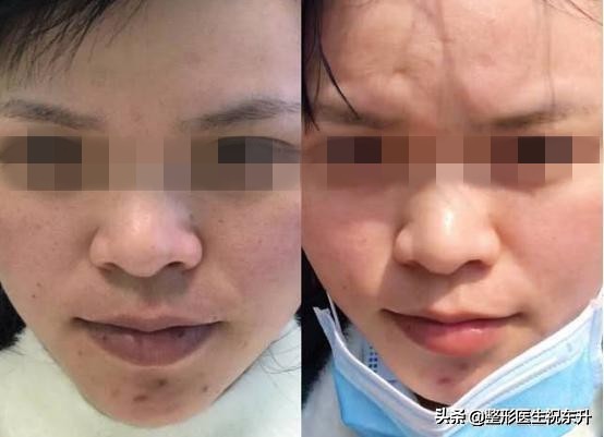 注射水光有效果吗,注射用水光针