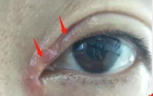 女子双眼皮整容失败,女子整容后惨不忍睹