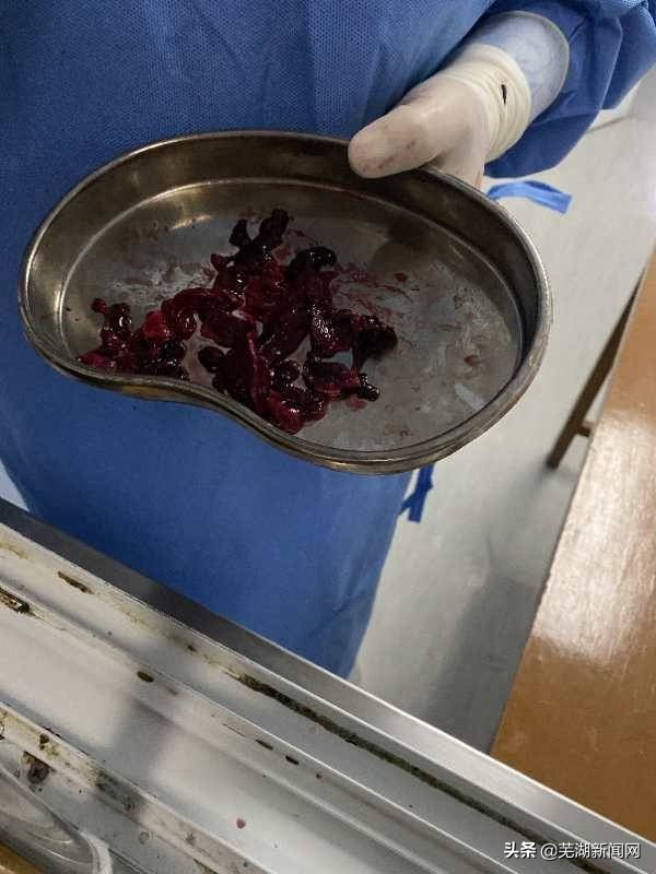 芜湖:网络主播为求美选择隆胸手术后却流血不止…