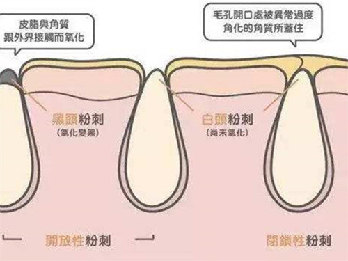 痘痘和闭口有什么区别,痘痘闭口怎么治才能彻底根除