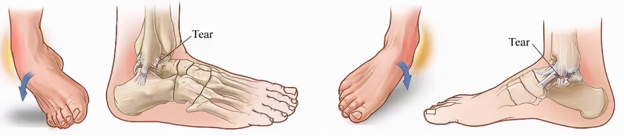 孩子脚扭伤了肿了怎么擦药水,小孩脚扭伤后热敷了怎么办