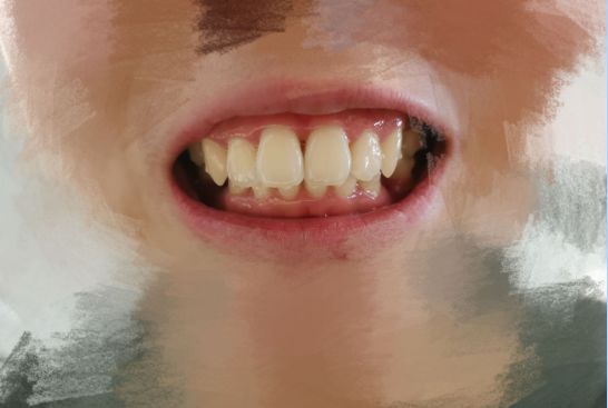 杭州牙齿龅牙矫正,牙齿矫正记录隐适美