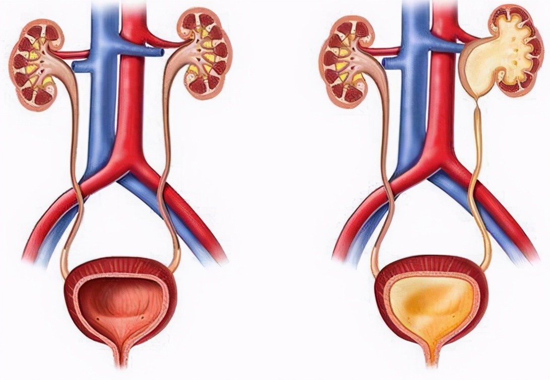 了解肾病的最佳方法,肾积水要及时治疗吗