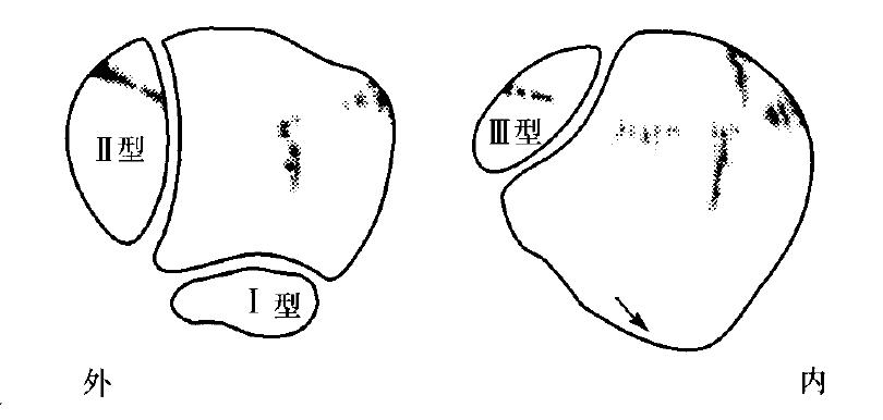膝盖痛髌骨上方有裂开要手术吗,膝盖髌骨后面突然像针扎一样疼