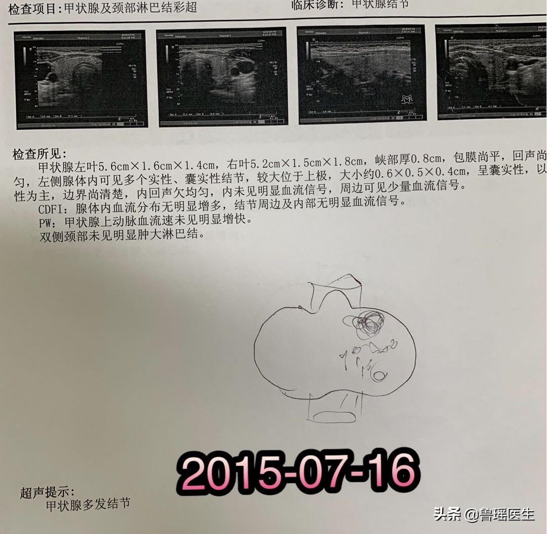 甲状腺穿刺v600e突变是什么意思,b超甲状腺结节误判率