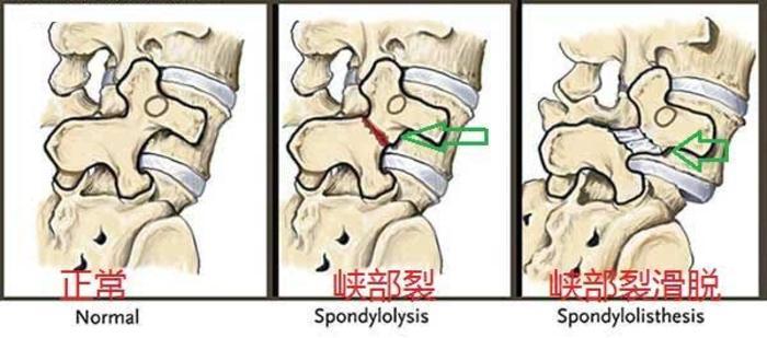 腰椎滑脱症是怎么回事,腰椎滑脱的症状怎么治疗吃啥药