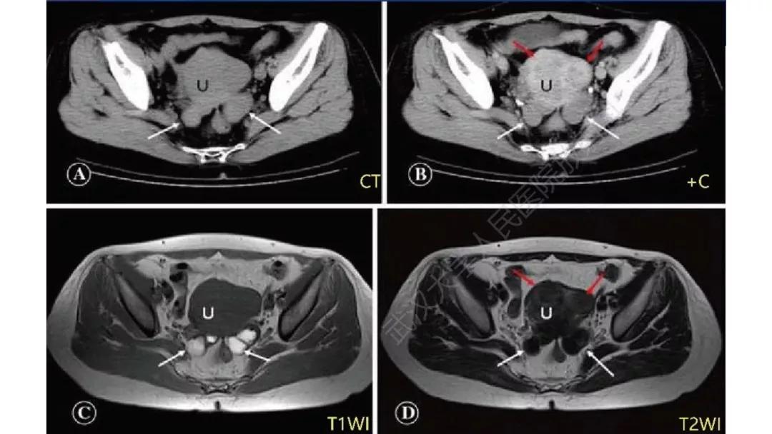 卵巢原发肿瘤的分析思路