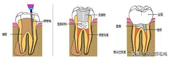 根管治疗后树脂填充还是戴牙冠好,根管治疗后的牙不疼用拔掉吗