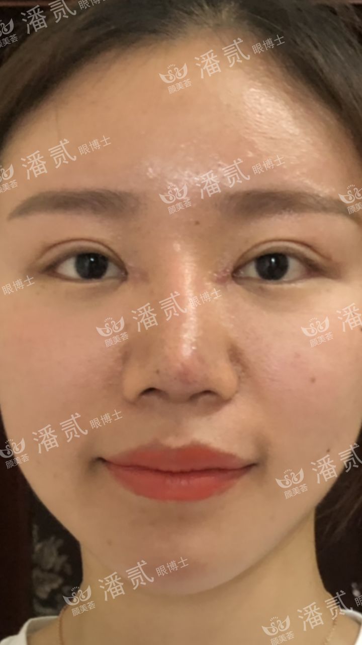 开眼角过大图片,开眼角过大修复效果图