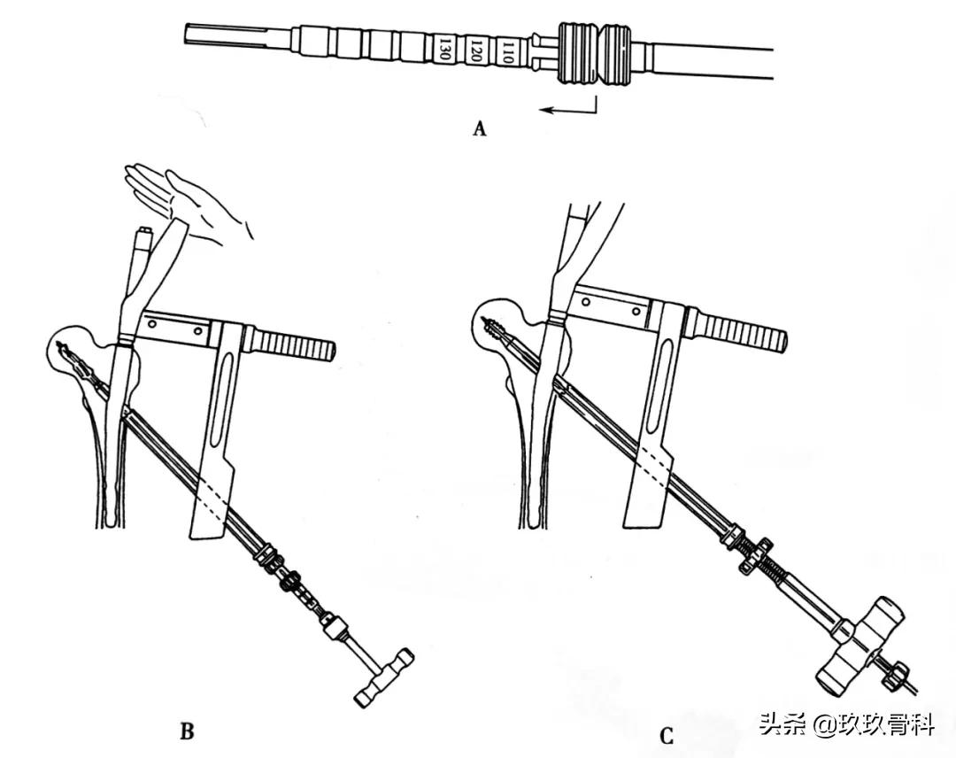 骨科用髓内钉什么材料,骨科髓内钉的作用