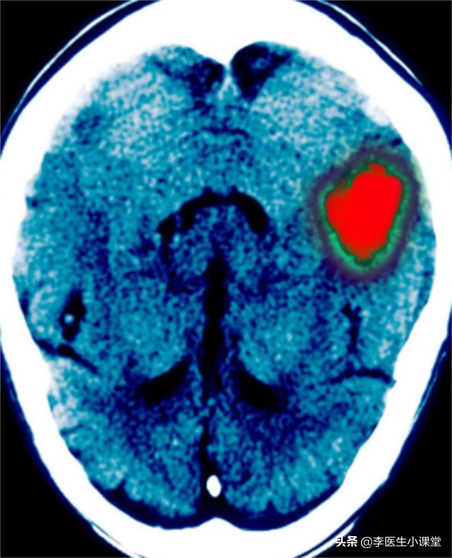 高血压引起脑出血急救方法,高血压脑出血晕倒一小时急救