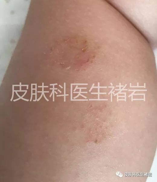湿疹到底长什么样,手脚湿疹长什么样