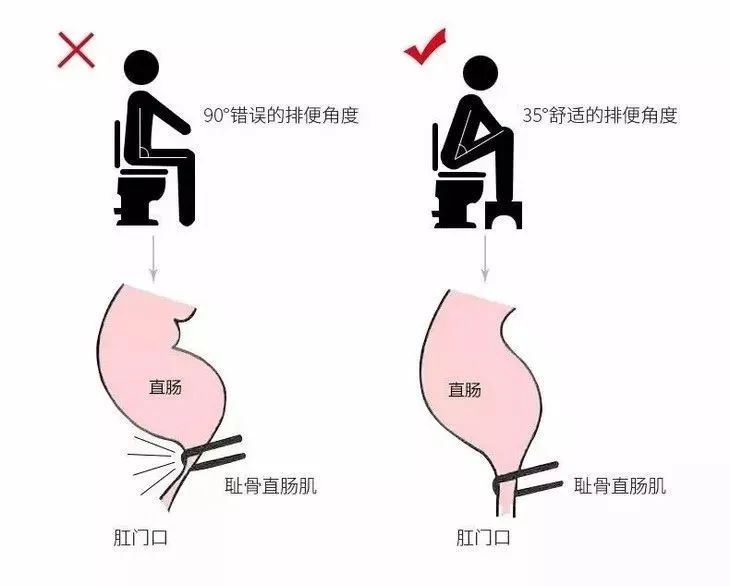 盆底肌真的可以治疗便秘,盆底肌跟便秘有关吗