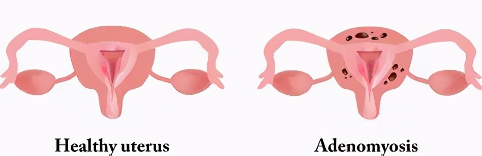 腺肌症第一针gnrha的最佳时间,腺肌症打完gnrha后需要做试管吗