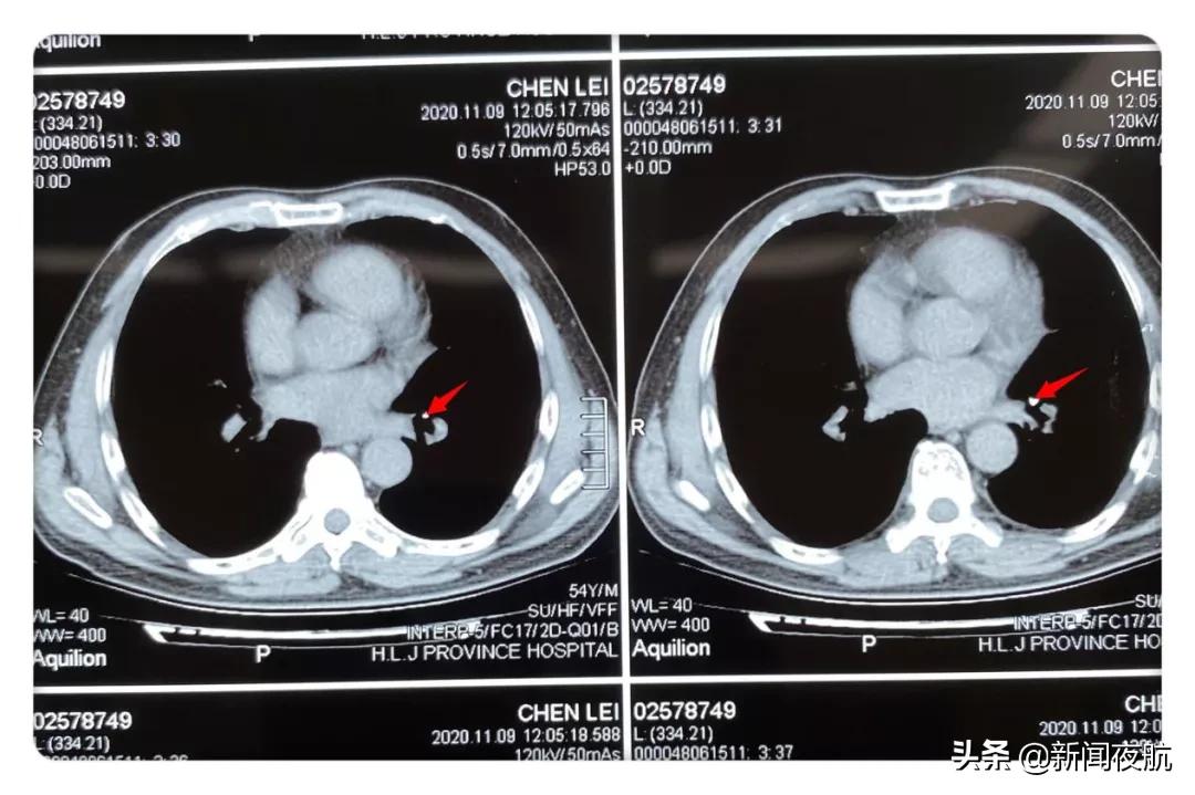 男子治牙，针却从嘴里掉进去了！做胃镜还没找到，针掉哪儿了？