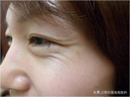 眉间除皱针的危害和副作用,除皱针祛额纹的危害和副作用