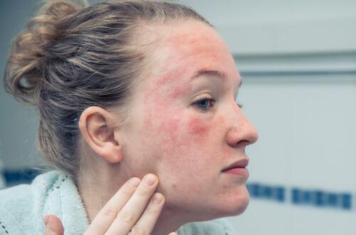 皮肤干燥过敏瘙痒中医方剂,中医实战笔记皮肤瘙痒过敏验方