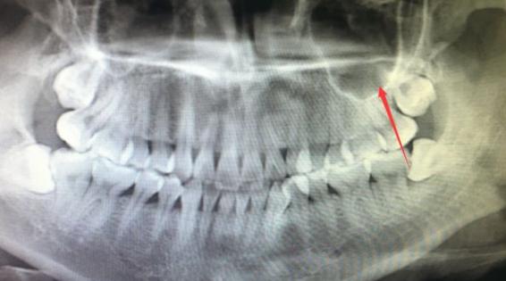 阿旺说趣事,阿旺同意做手术